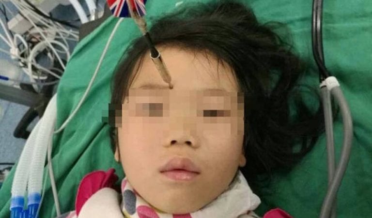 7-Year-Old Chinese Boy Accidentally Throws 4-Inch Dart at His Sister’s Forehead
