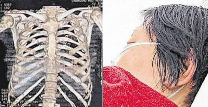 Son Beats Up Old Mother in China Leaving Her With 11 Broken Ribs