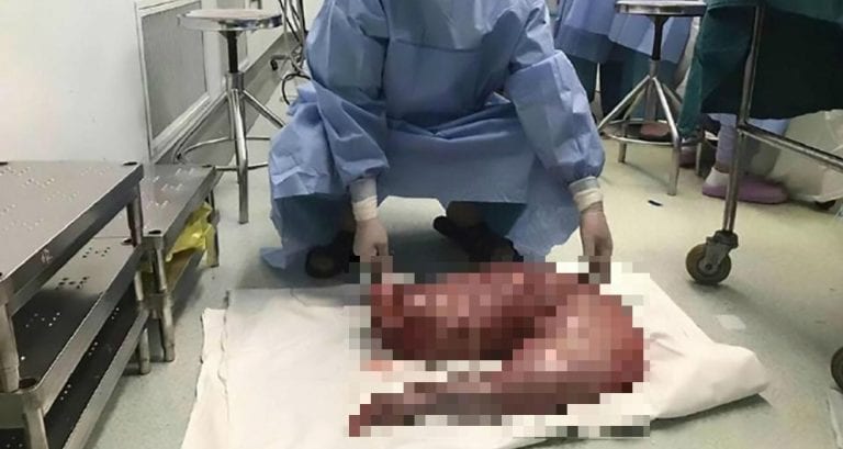 Chinese Surgeons Remove 30 Inches of Man’s Intestines to Relieve Painful Constipation