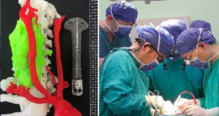 Chinese Doctors Replace Cancer Patient’s Spine With 3D Printed Vertebrae