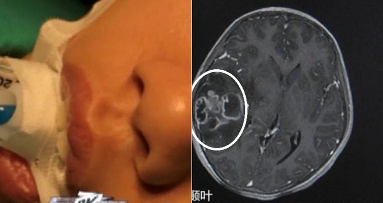 Girl in China Needs Skull Surgery After Trying to Remove Blackhead
