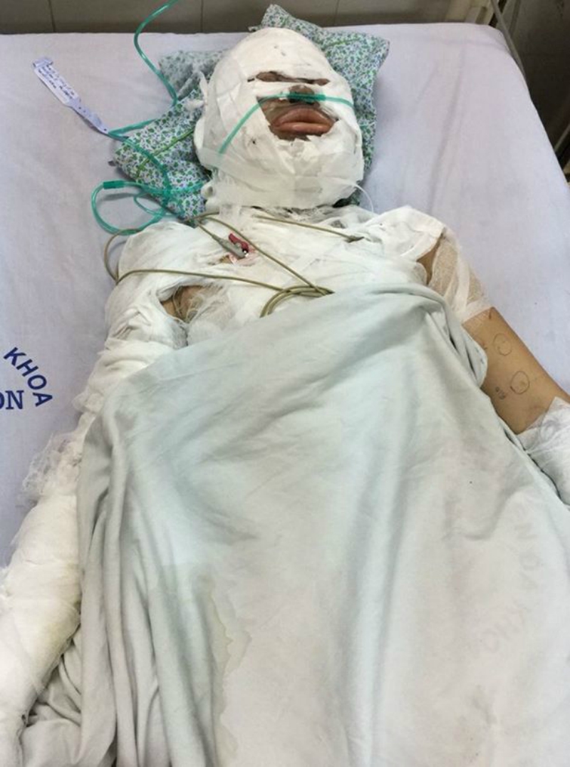 vietnamese woman burned
