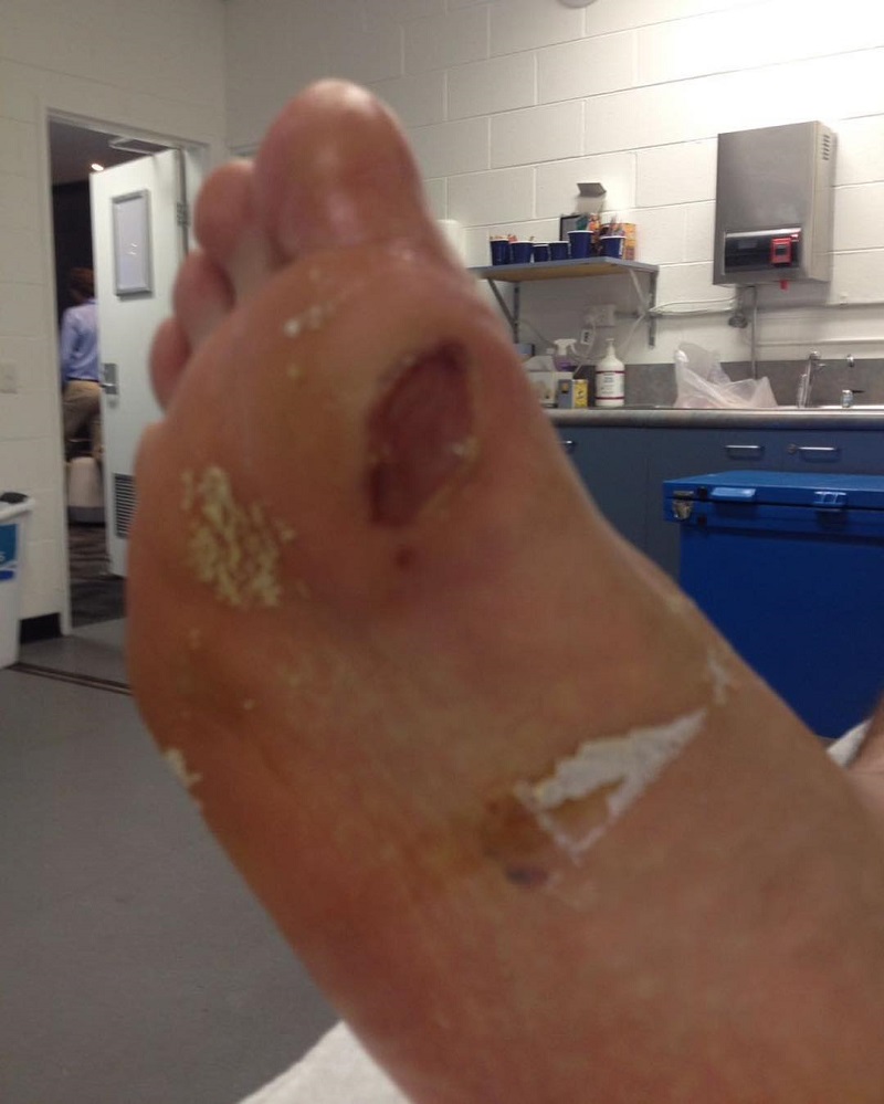 hyeon chung blister