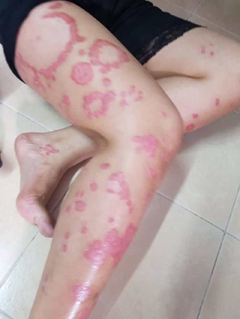 thai woman suspended from job after customers thought her psoriasis was aids