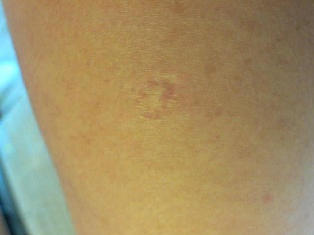 vaccine scar