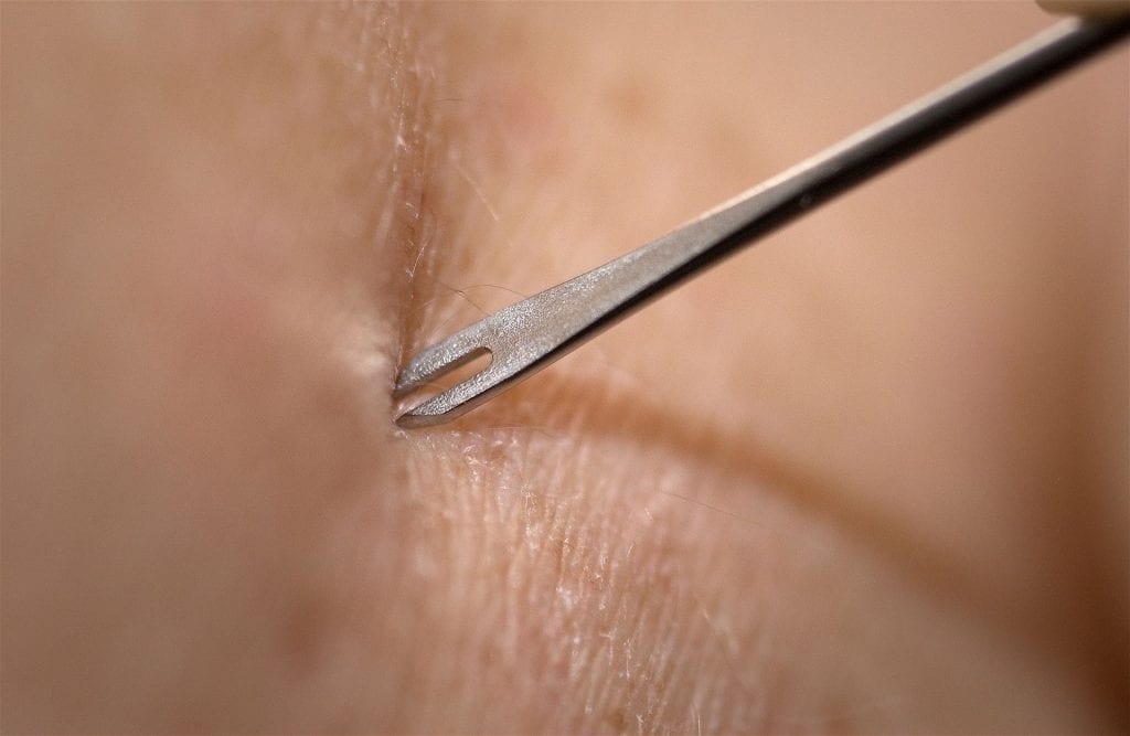 bifurcated needle