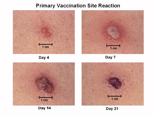 smallpox vaccine