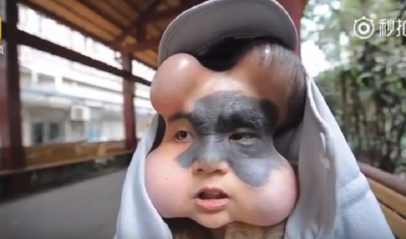 congenital melanocytic nevus