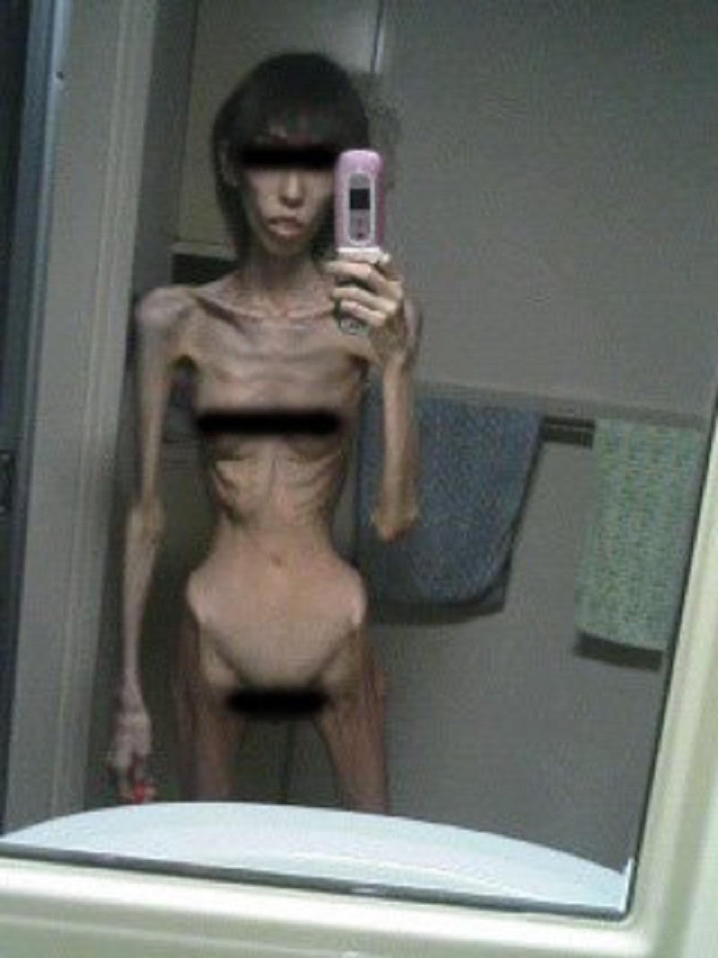 anorexia