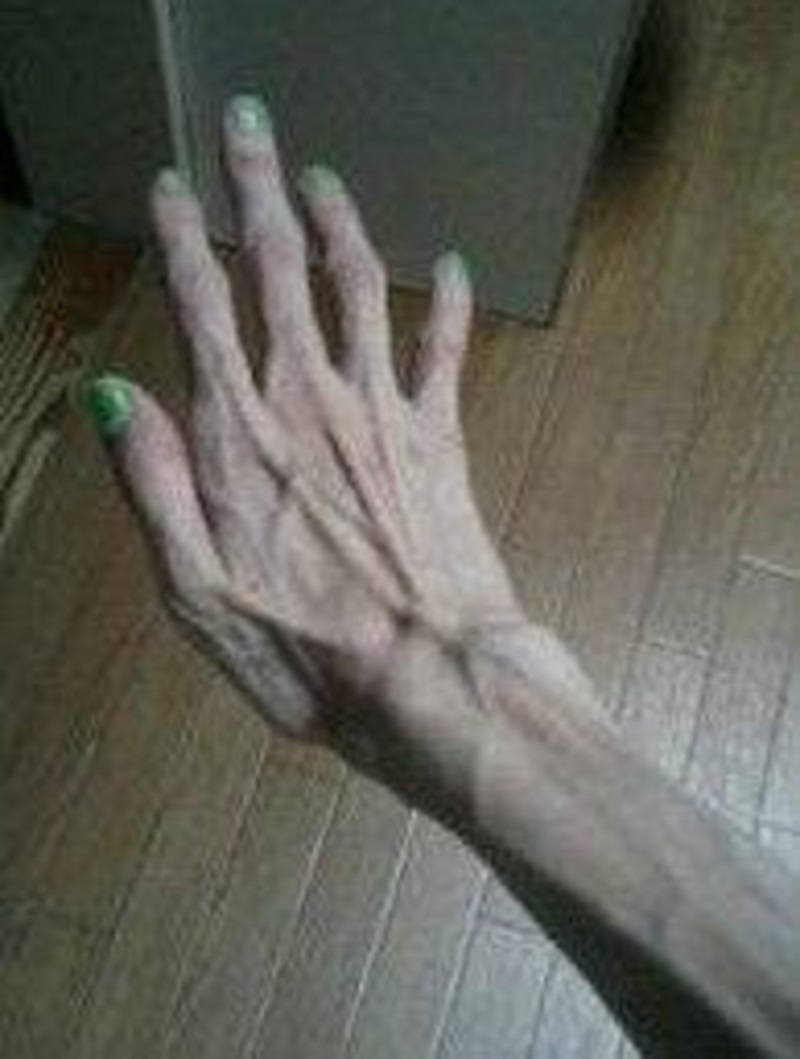 anorexia