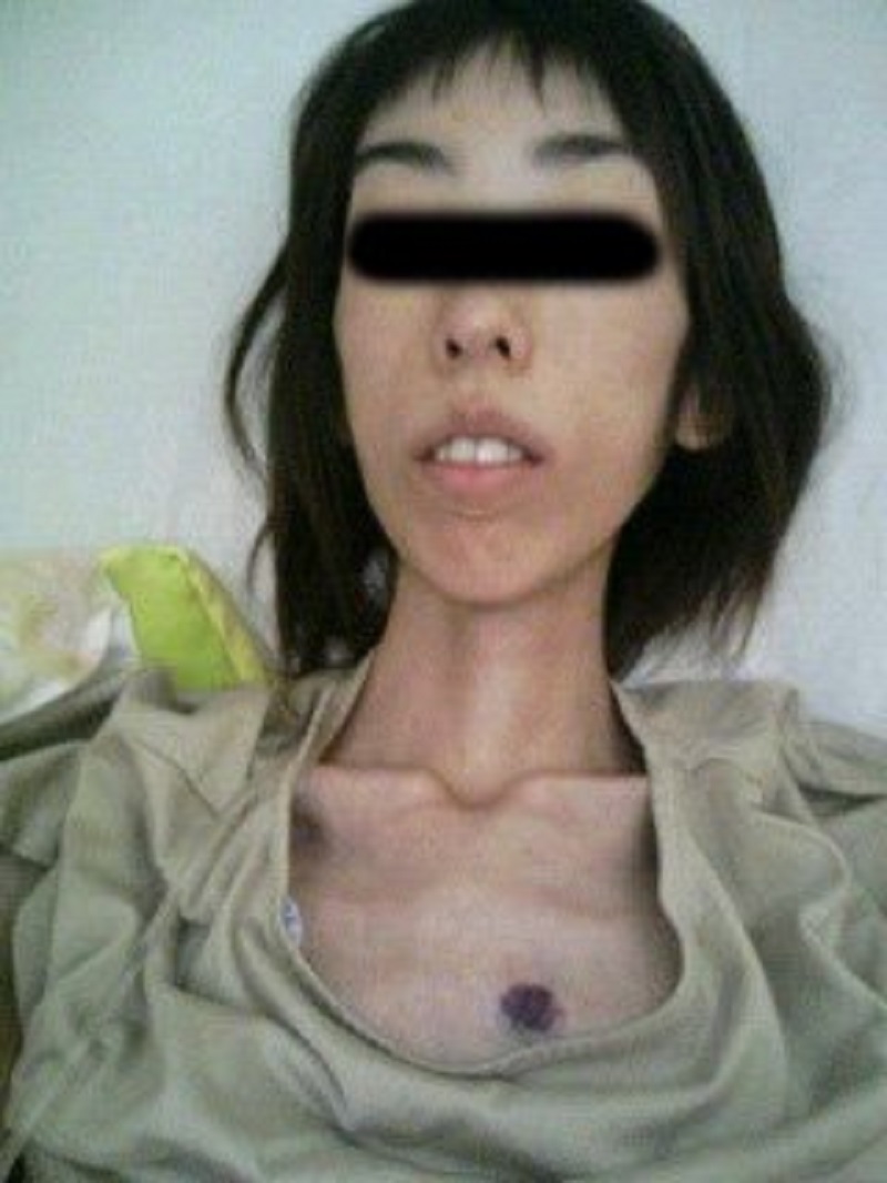 anorexia