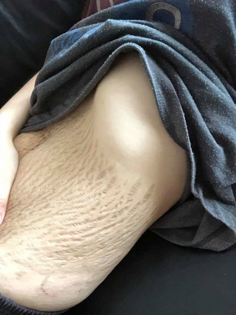 Stretch Marks