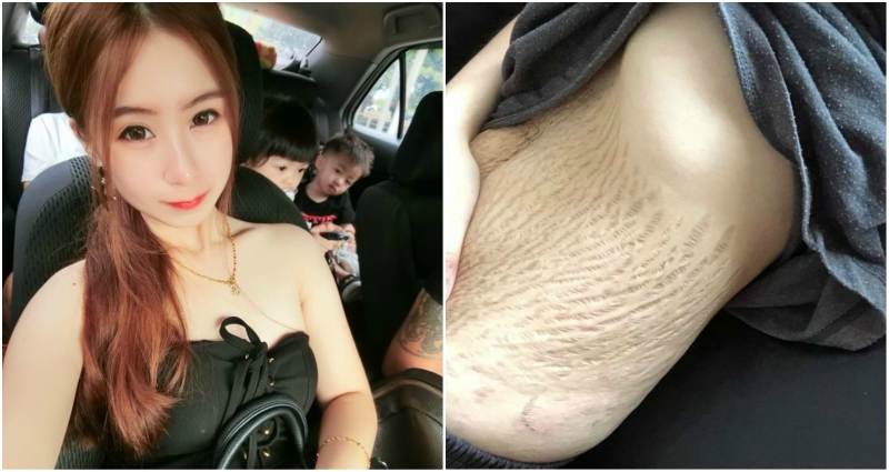 Stretch Marks