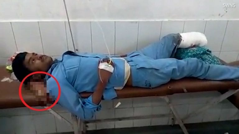 Car Accident Victim Uses Own Amputated Foot As Pillow When Hospital in India Doesn’t Treat Him