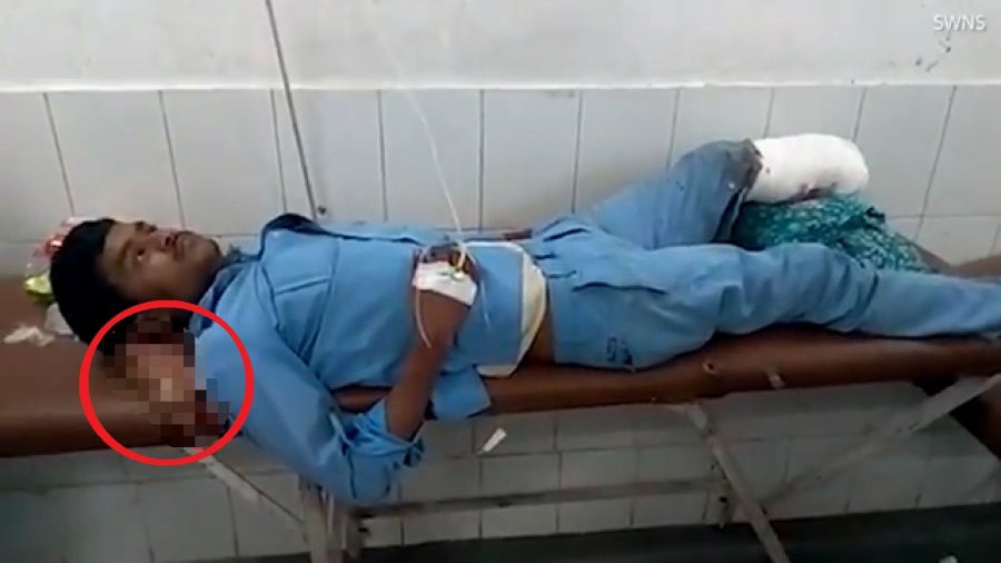Car Accident Victim Uses Own Amputated Foot As Pillow When Hospital in India Doesn’t Treat Him