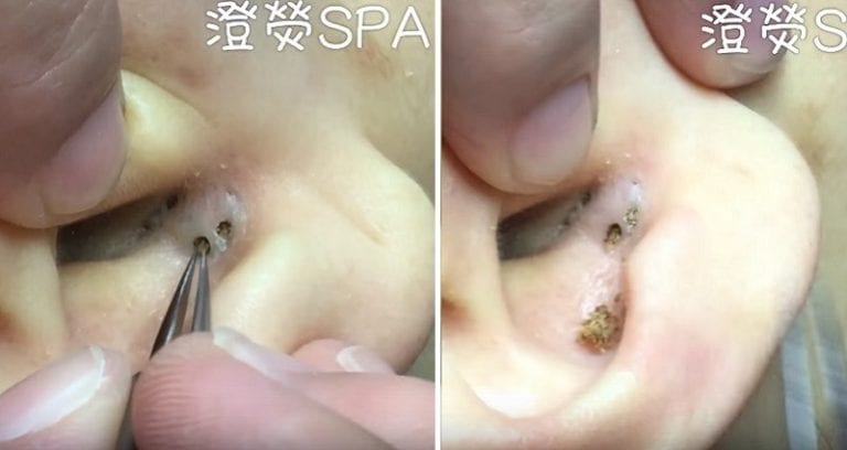 Blackhead Extraction Video from Chinese Spa is for Pimple Popping Diehards Only