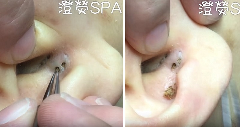 Blackhead Extraction from Chinese Spa for Pimple Popping Diehards Only |