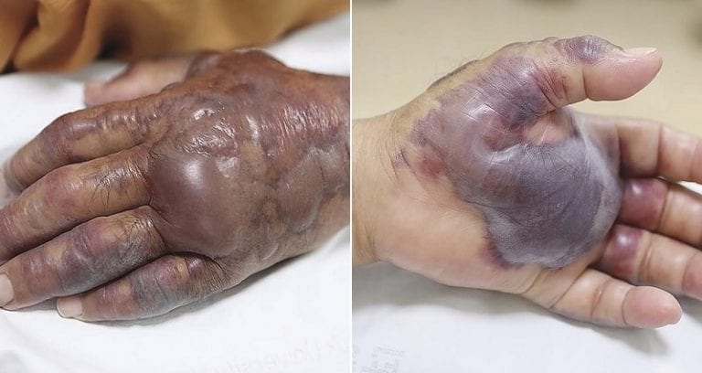 South Korean Man’s Arm Amputated After Infection From Eating Sushi