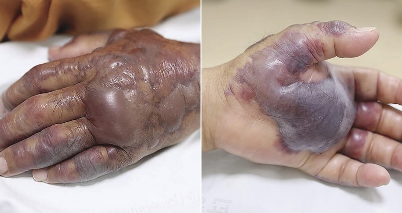 South Korean Man’s Arm Amputated After Infection From Eating Sushi