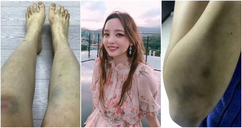 Former K-Pop Idol Posts Disturbing Photos After Boyfriend Allegedly Assaults Her