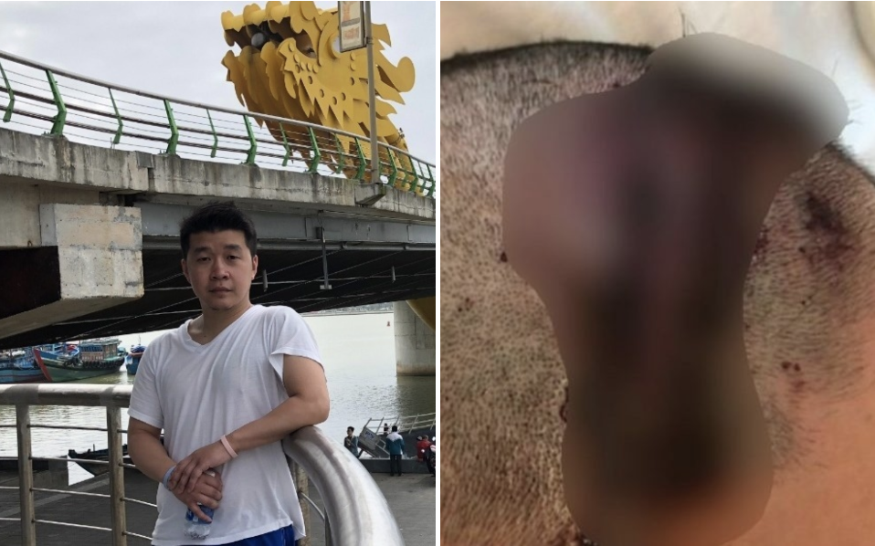 Man Left with F‌ract‌ur‌ed S‌kull After Being A‌‌s‌sa‌‌u‌lt‌e‌‌‌d by 6 Men On His Way to Work