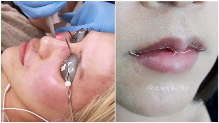 6 Shocking Cosmetic Enhancement Procedures Commonly Used by Asian Idols