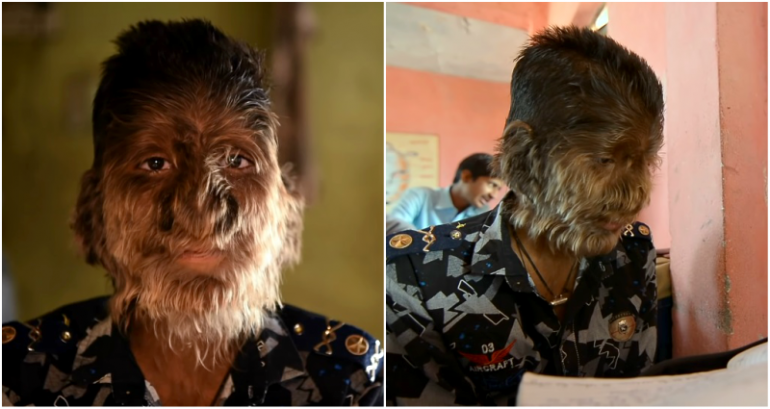 Indian Teen’s Rare Condition Lands Him the Name ‘Werewolf Boy’