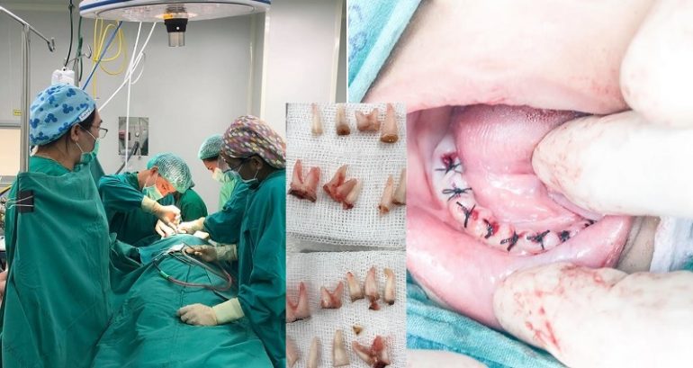 Boy Gets 18 Teeth Pulled Because He Refused to Brush After Drinking Milk