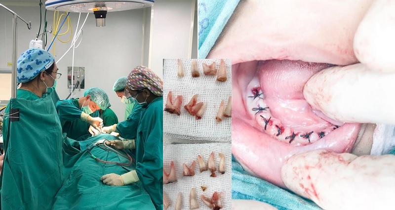Boy Gets 18 Teeth Pulled Because He Refused to Brush After Drinking Milk