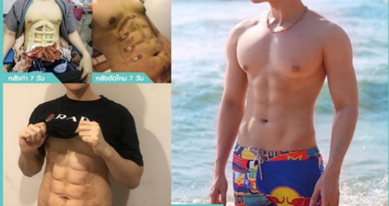 Thai Clinic Now Offers Plastic Surgery for 6-Pack Abs