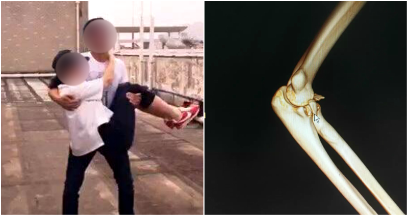 Man Fractures Arm, Dislocates Elbow Trying to ‘Princess Carry’ His Girlfriend