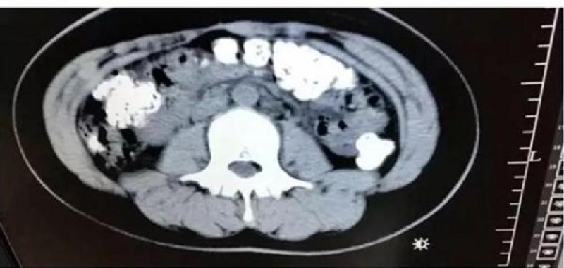A 14-year-old girl from China was sent to the hospital after suffering from a bad case of constipation that lasted for five days.