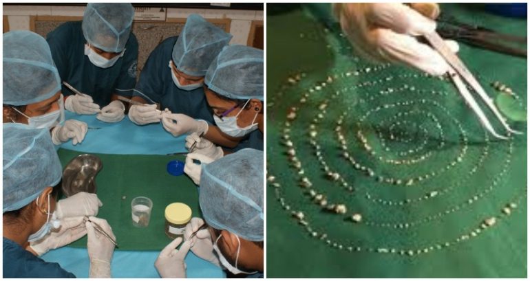 Doctors in India Remove Over 500 Teeth From 7-Year-Old Boy’s Mouth