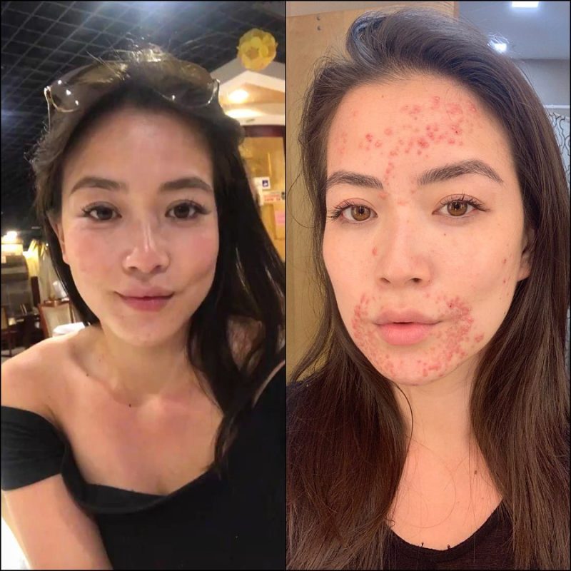 A local CBS News anchor stepped out of the shadows to reveal a skin condition that has covered her face for months, relieving herself of the emotional exhaustion that came with hiding it.