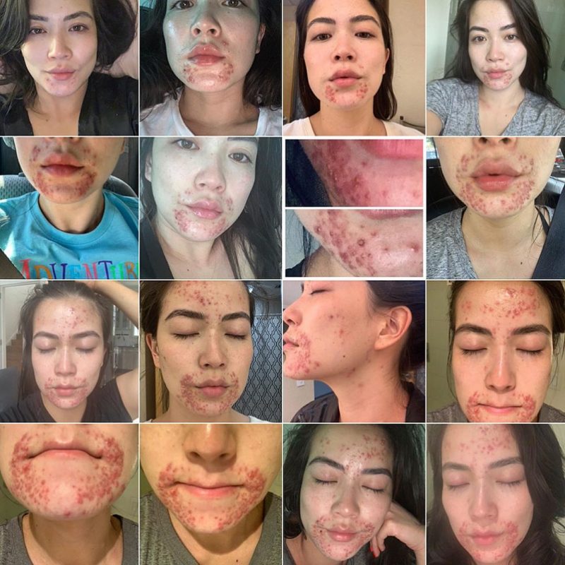 A local CBS News anchor stepped out of the shadows to reveal a skin condition that has covered her face for months, relieving herself of the emotional exhaustion that came with hiding it.
