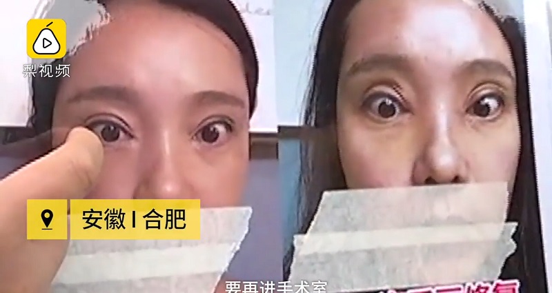 Woman Can't Close Her Eyes After 2 Botched Double Eyelid Surgeries