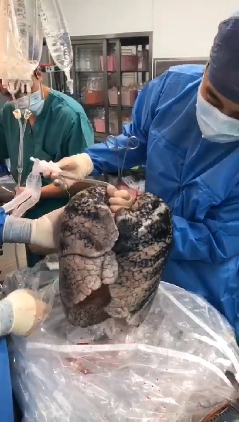 A surgeon from China rejected a pair of donated blackened lungs that came from a heavy-smoker.