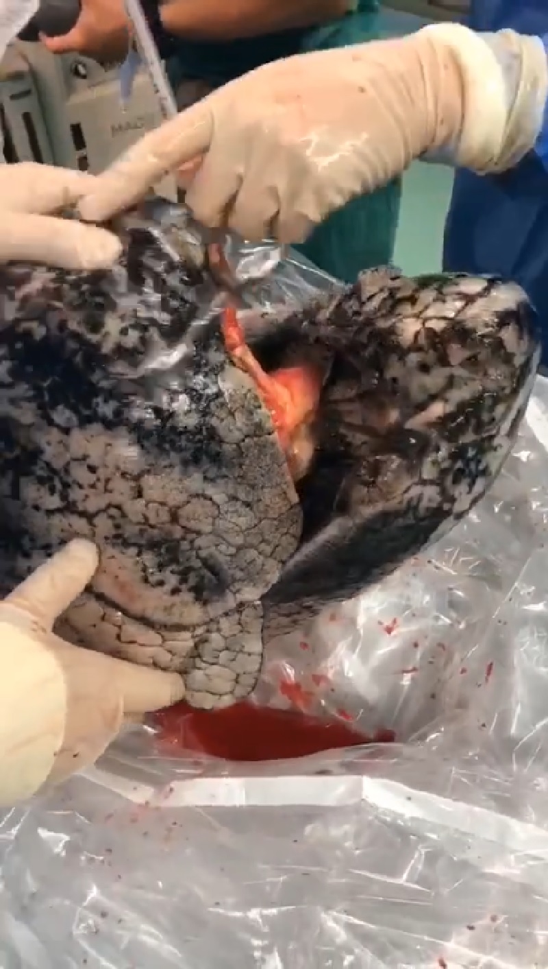 A surgeon from China rejected a pair of donated blackened lungs that came from a heavy-smoker.