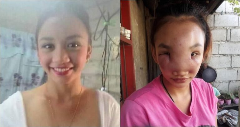 Filipina Mother Suffers From Mysterious Swelling During Pregnancy