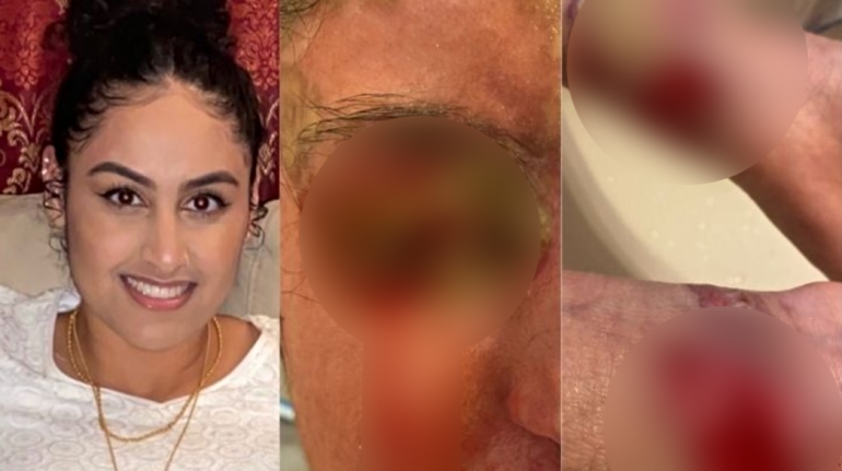 Pakistani College Student Survives ACID Attack Outside Her NY Home