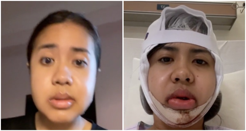 Singaporean student shares her $26,000 jaw surgery journey in viral TikTok video