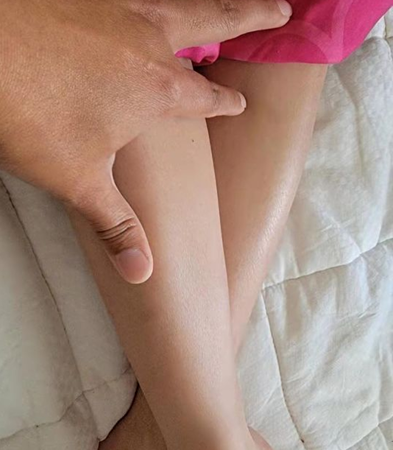 EMMA INJURY