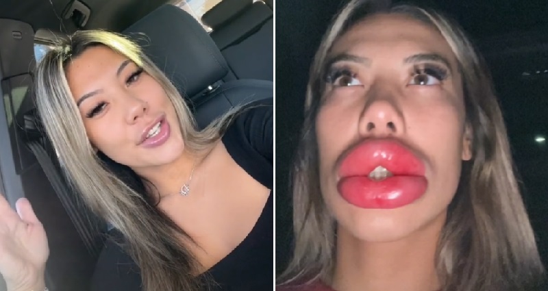 accidentally used straw after lip filler｜TikTok Search