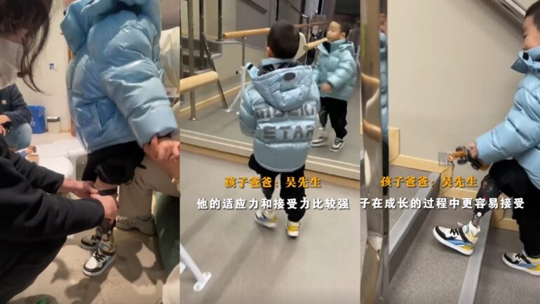 Chinese toddler receives custom prosthetic leg in heartwarming video