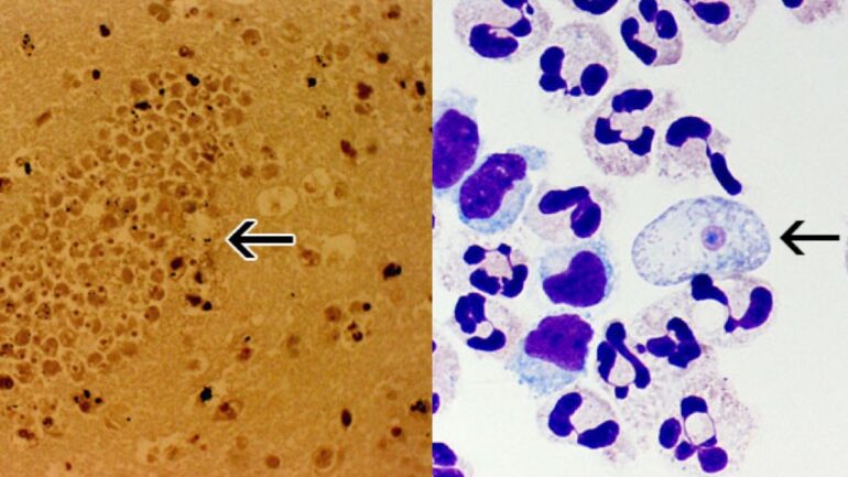 South Korean man dies due to ‘brain-eating amoeba’