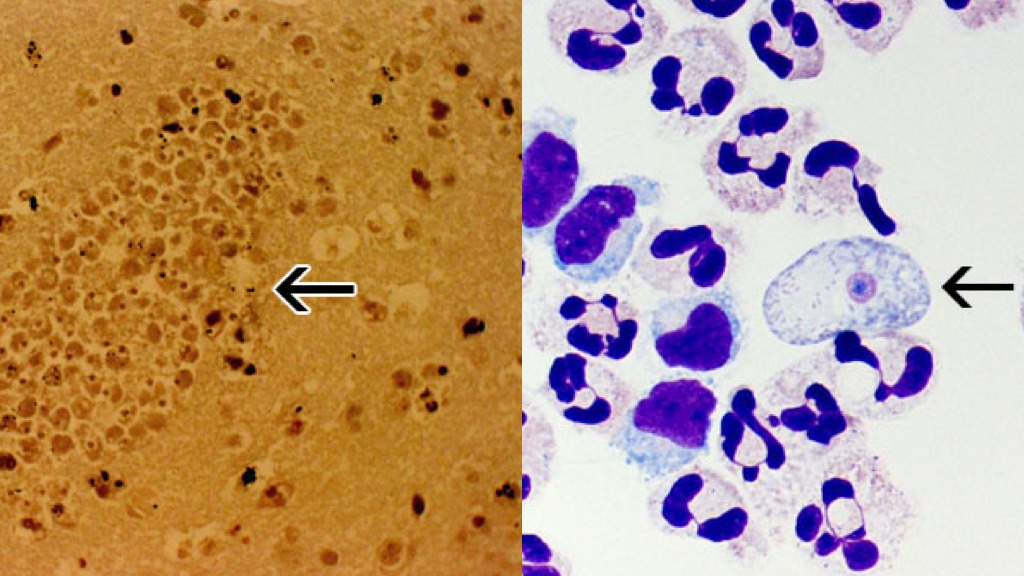 Brain-eating amoeba