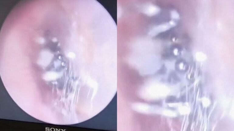 Video: Doctor in China discovers live spider nesting inside woman’s ear