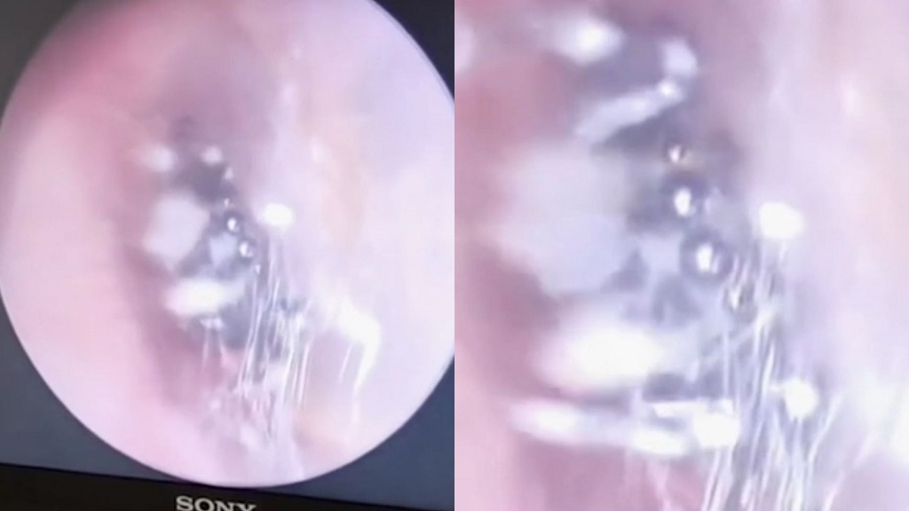 Spider in ear canal