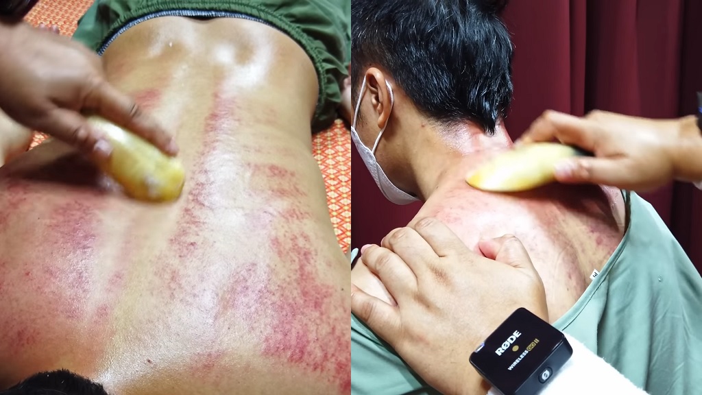 Gua sha explained: Origins, reported benefits and side effects - Vimarsana News
