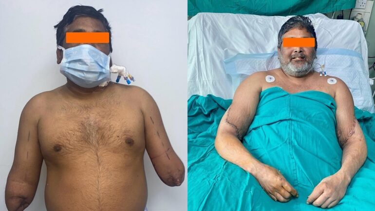 Indian painter gets brain-dead woman’s hands in rare bilateral hand transplant